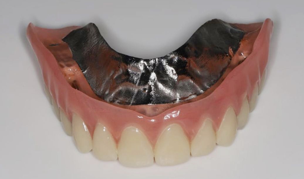 Prothèse adjointe sur mesure avec armature métallique Prothèse dentaire adjointe avec armature métallique – Laboratoire Stenger Thionville