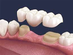Prothèse conjointe céramique – Couronnes et bridge sur mesure Modèle 3D de prothèse conjointe avec couronnes et bridge – Laboratoire dentaire à Thionville